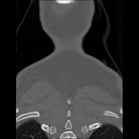 File:Cervical rib (Radiopaedia 71110-81363 Coronal non-contrast 6).jpg