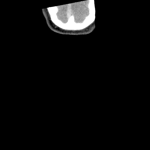 Cervical schwannoma (Radiopaedia 57979-64974 G 67).png