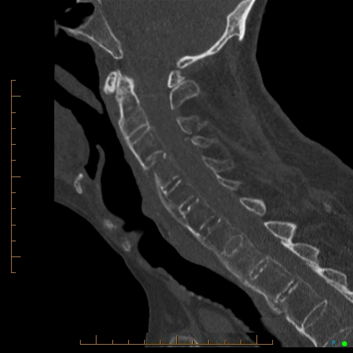 Cervical spine fracture - ankylosing spondylitis (Radiopaedia 76835-88706 Sagittal bone window 59).jpg
