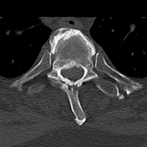Cervical spine fracture - chalk stick (Radiopaedia 39116-41323 Axial bone window 101).png