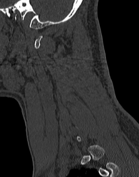 Cervical spondylodiscitis (Radiopaedia 28057-29489 Sagittal bone window 15).jpg