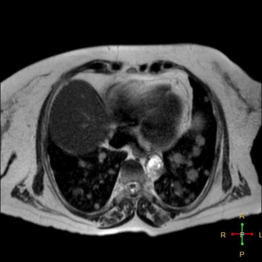 File:Cervical stump squamous cell carcinoma (Radiopaedia 48049-52858 I 20).jpg