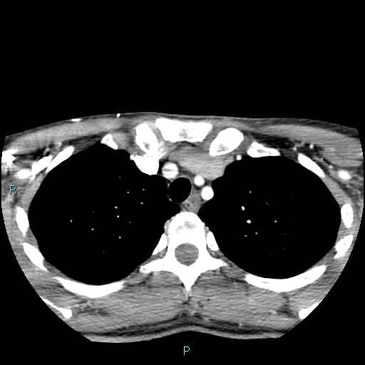 Cervical thymic cyst (Radiopaedia 88632-105335 B 13).jpg