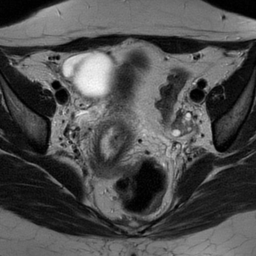 File:Cesarean scar ectopic pregnancy (Radiopaedia 77286-89362 Axial T2 20).jpg