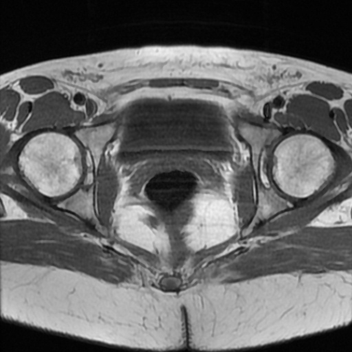 File:Cesarian section scar endometriosis (Radiopaedia 66520-75799 Axial T1 19).jpg