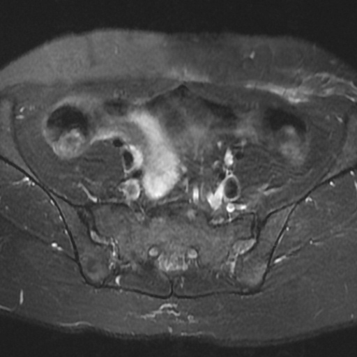 File:Cesarian section scar endometriosis (Radiopaedia 66520-75799 Axial T2 fat sat 2).jpg