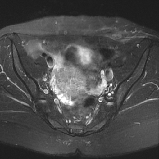 File:Cesarian section scar endometriosis (Radiopaedia 66520-75799 Axial T2 fat sat 9).jpg