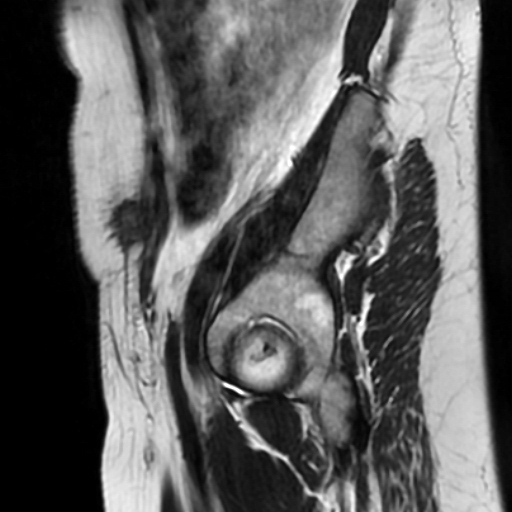 File:Cesarian section scar endometriosis (Radiopaedia 66520-75799 Sagittal T2 15).jpg