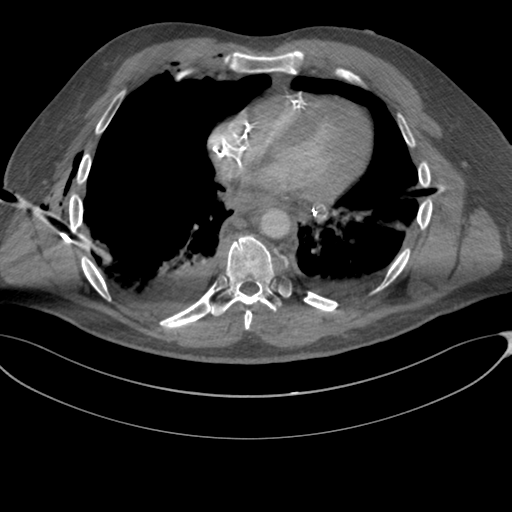 File:Chest multitrauma - aortic injury (Radiopaedia 34708-36147 A 194).png