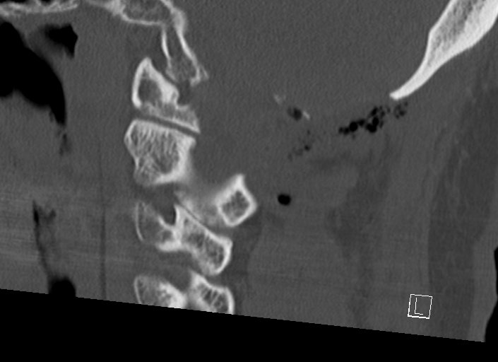 Chiari I malformation with a symptomatic syrinx of the posterolateral medulla oblongata (Radiopaedia 42573-45707 A 36).jpg