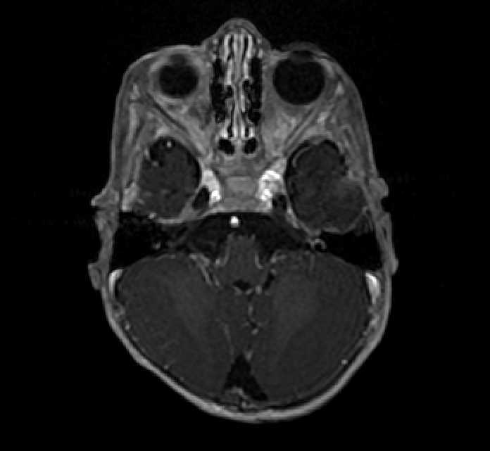 Chiasmatic-hypothalamic glioma (Radiopaedia 90079-107252 Axial T1 C+ 17).jpg