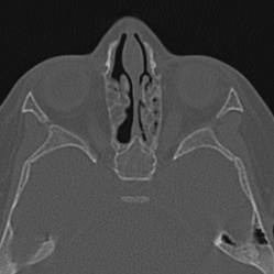 Choanal atresia (Radiopaedia 88525-105975 Axial bone window 65).jpg