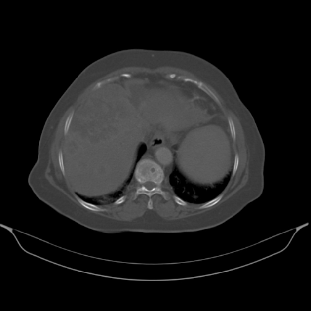 Cholangiocarcinoma (Radiopaedia 50592-56025 Axial bone window 11).jpg