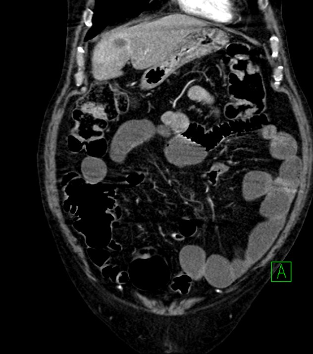 Cholangiocarcinoma with cerebral metastases (Radiopaedia 83519-98629 E 26).jpg