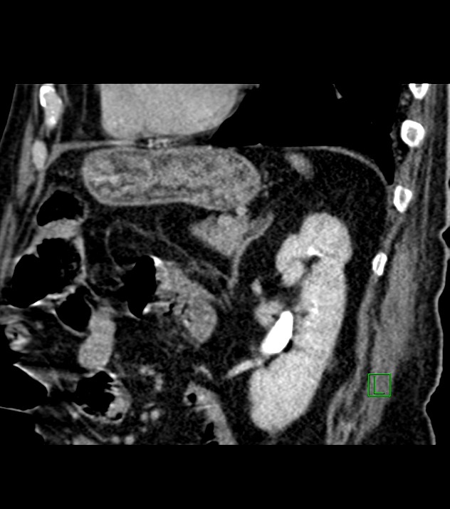 Cholangiocarcinoma with cerebral metastases (Radiopaedia 83519-98629 Sagittal C+ delayed 38).jpg