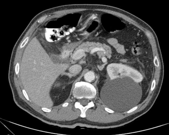 Cholecystitis - perforated gallbladder (Radiopaedia 57038-63916 A 30).jpg