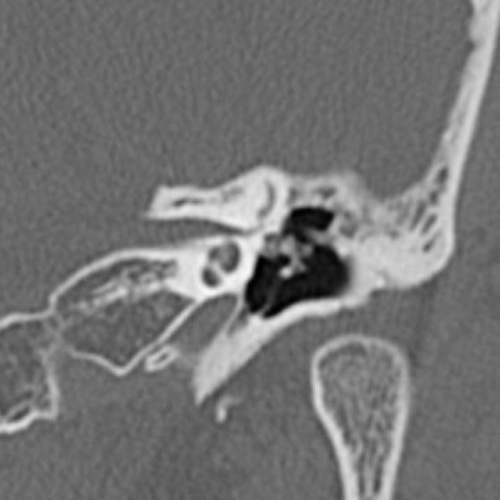 File:Cholesteatoma (Radiopaedia 9408-10093 Coronal bone window 10).jpg