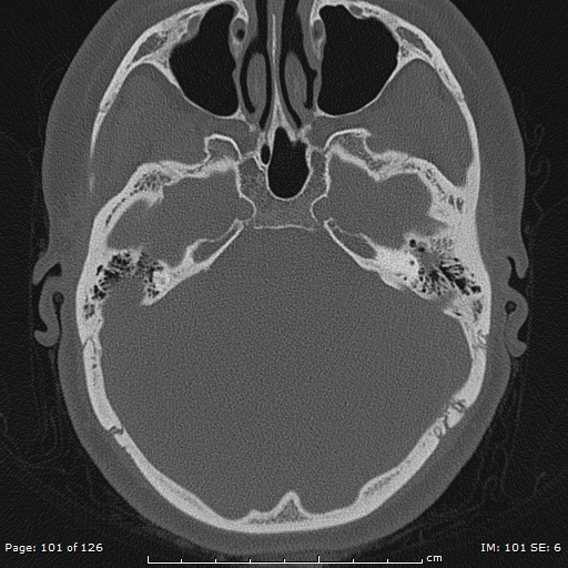 Cholesteatoma - external auditory canal (Radiopaedia 88452-105096 Axial bone window 64).jpg