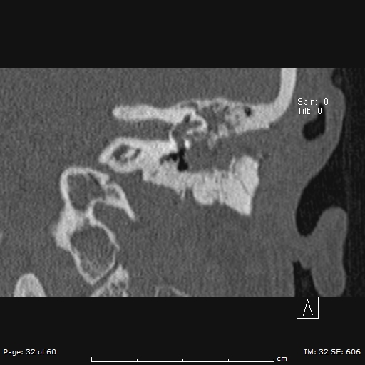 File:Cholesteatoma - external auditory canal (Radiopaedia 88452-105096 Coronal bone window 32).jpg