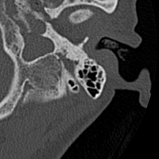 File:Cholesteatoma of the external ear (Radiopaedia 16540-16225 Axial bone window 32).jpg