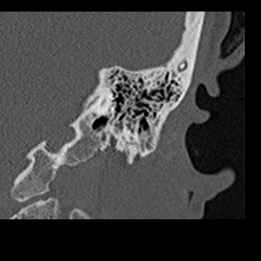File:Cholesteatoma of the external ear (Radiopaedia 16540-16225 Coronal bone window 21).jpg