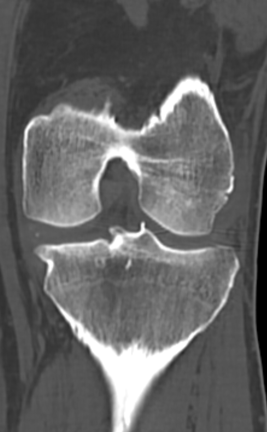 Chondrocalcinosis (Radiopaedia 82862-97173 Coronal bone window 50).jpg