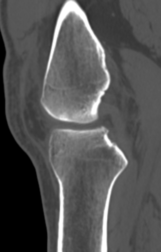 Chondrocalcinosis (Radiopaedia 82862-97173 Sagittal bone window 27).jpg