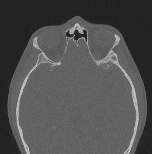 Chondrosarcoma (clivus) (Radiopaedia 46895-51425 Axial bone window 18).png