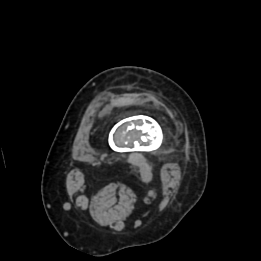 File:Chondrosarcoma - femur (Radiopaedia 64187-72954 Axial non-contrast 22).jpg