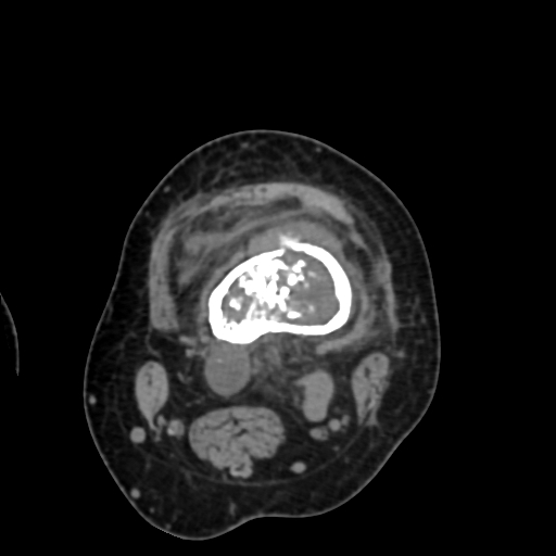 Chondrosarcoma - femur (Radiopaedia 64187-72954 Axial non-contrast 31).jpg