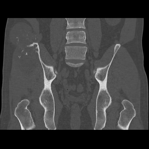Chondrosarcoma of iliac wing (Radiopaedia 63861-72599 Coronal bone window 70).jpg