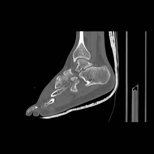 File:Chopart fracture (Radiopaedia 12386-12650 Sagittal bone window 18).jpg