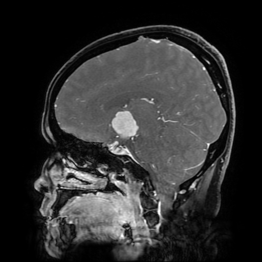 File:Chordoid glioma of third ventricle (Radiopaedia 91612-109340 F 118).jpg