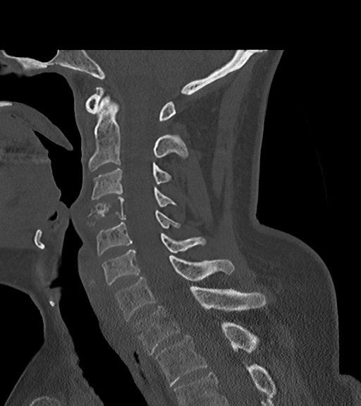 File:Chordoma (C4 vertebra) (Radiopaedia 47561-52188 Sagittal bone window 38).png