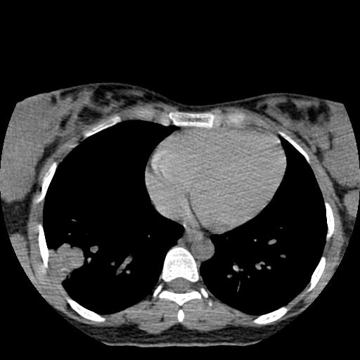 File:Choriocarcinoma of ovary with cerebral and pulmonary metastases (Radiopaedia 25983-26119 Axial non-contrast 8).jpg