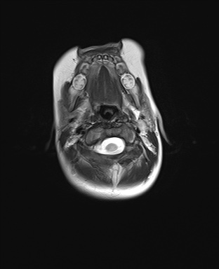 File:Choroid plexus papilloma (Radiopaedia 84612-100019 Axial T2 1).jpg