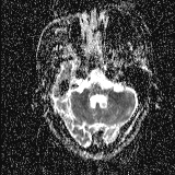 Choroid plexus xanthogranuloma - unilateral (Radiopaedia 85632-101393 Axial ADC 14).jpg