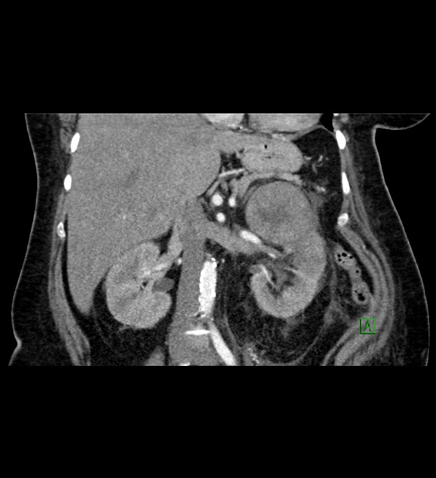 Chromophobe renal cell carcinoma (Radiopaedia 84239-99519 C 47).jpg