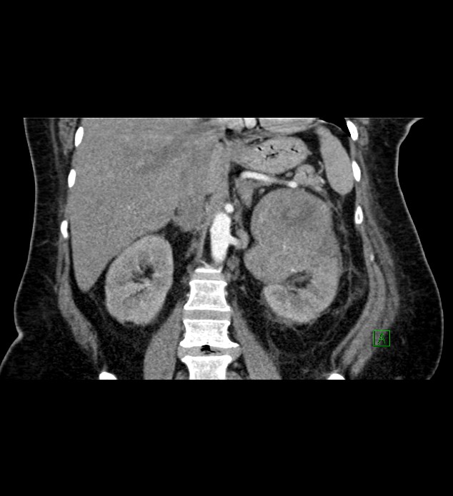 Chromophobe renal cell carcinoma (Radiopaedia 84239-99519 C 53).jpg