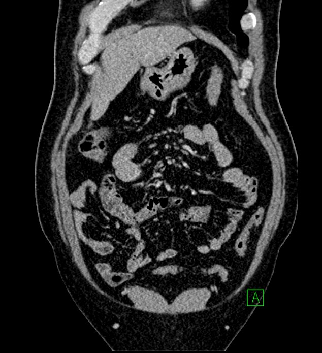 Chromophobe renal cell carcinoma (Radiopaedia 84286-99573 H 44).jpg