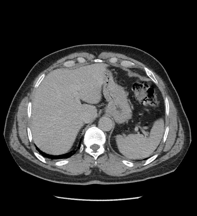 Chromophobe renal cell carcinoma (Radiopaedia 86879-103083 D 23).jpg