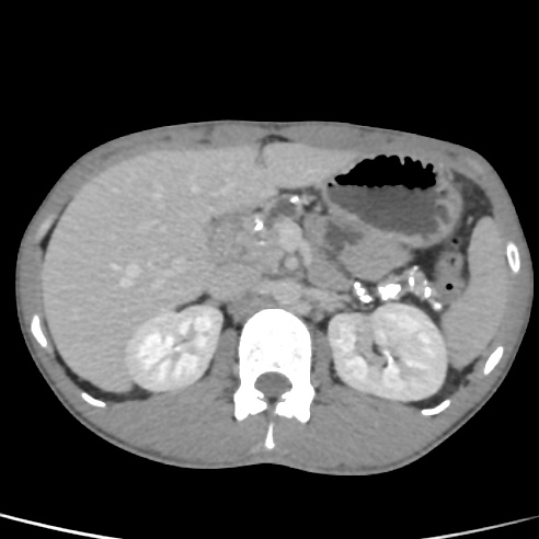 File:Chronic calcific pancreatitis (Radiopaedia 56280-62953 C 14).jpg