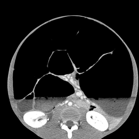 Chronic large bowel pseudo-obstruction (Radiopaedia 43181-46492 A 94).jpg