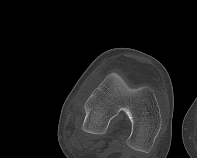 Chronic ostemyelitis of the femur with long sinus tract (Radiopaedia 74947-85982 Axial bone window 221).jpg