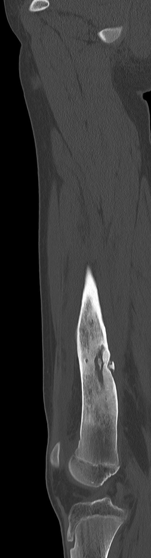 Chronic ostemyelitis of the femur with long sinus tract (Radiopaedia 74947-85982 Sagittal bone window 55).jpg