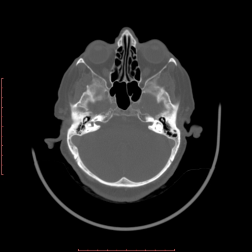 Chronic osteomyelitis - maxilla (Radiopaedia 23783-23927 Axial bone window 125).jpg
