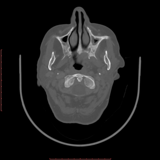 Chronic osteomyelitis - maxilla (Radiopaedia 23783-23927 Axial bone window 93).jpg