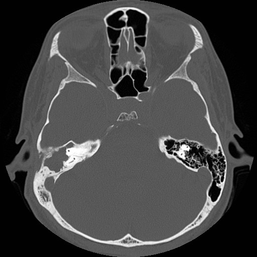 File:Chronic otomastoiditis (Radiopaedia 27138-27309 Axial bone window 43).jpg