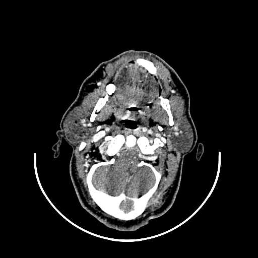 File:Chronic submandibular abscess (Radiopaedia 21738-21718 A 11).jpg