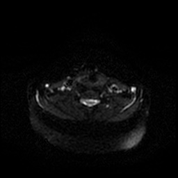 Chronic submandibular sialadenitis (Radiopaedia 61852-69885 Axial DWI 51).jpg